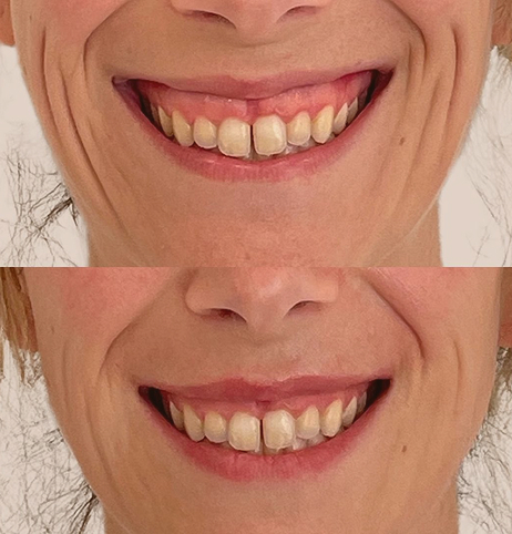1 sonrisa gingival sandra grohs