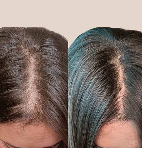 Tratamiento medicina regenerativa