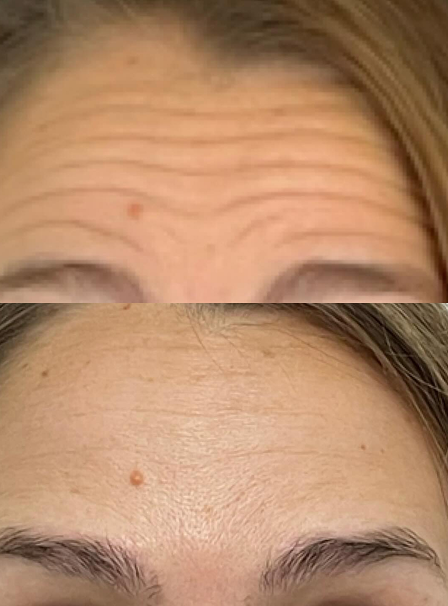 Tratamiento neomoduladores