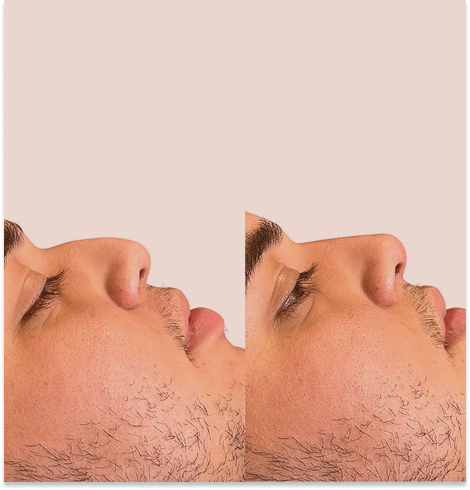 Tratamiento rinomodelacion