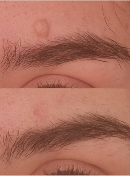 eliminacion verrugas