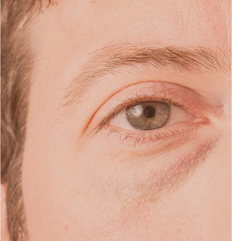 Sandra_Grohs_Tratamientos_Acido_hialuronico